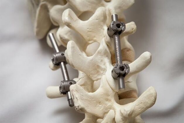 Osteocondroza simptomelor coloanei vertebrale lombare și tratament
